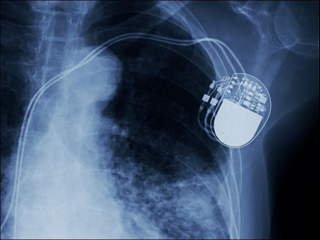 X-ray showing an implanted pacemaker.