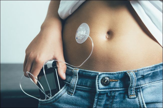 Insulin pump in a person's jeans pocket and attached to their stomach.