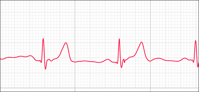 preview image showing ECG track