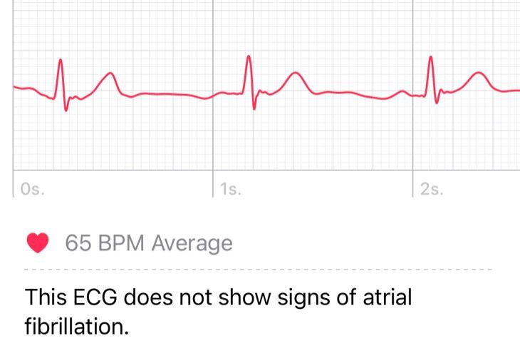 ECG result from Apple Watch